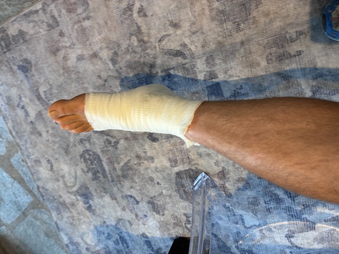 Ankle wrapped in a bandage after the hospital visit