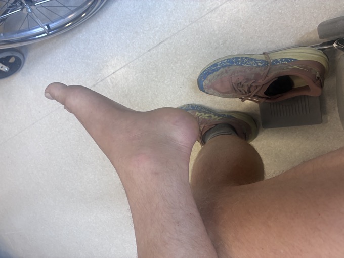 Foot propped on a wheelchair footrest in the emergency room